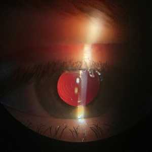 Rayner Trifocal в глазу